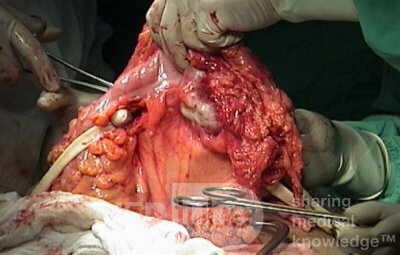 Metastasis of Renal Carcinoma to the ascending colon (7 of 11)