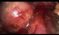 Retroperitoneoscopic Partial Nephrectomy