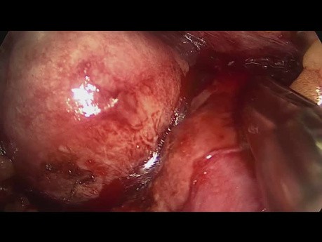 Retroperitoneoscopic Partial Nephrectomy