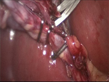 Laparoscopic Cholecystectomy and Appendicectomy - Same Ports