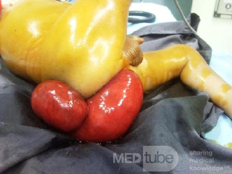 Rectal Prolapse In A Small Child