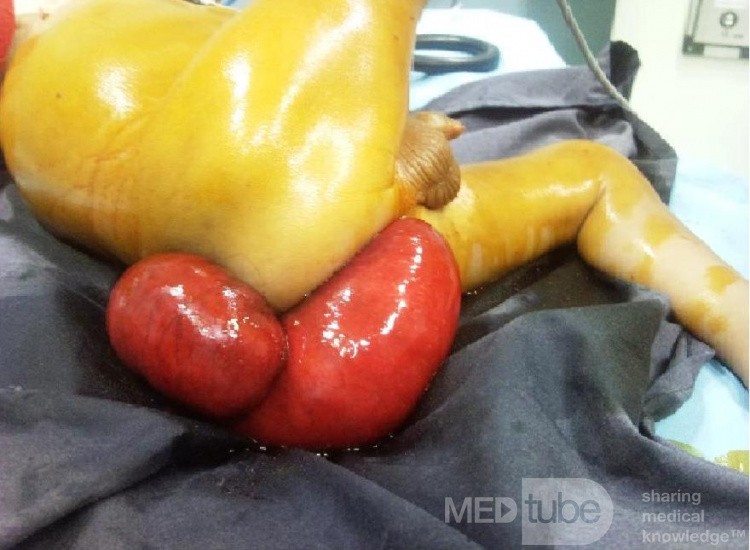 Rectal Prolapse In A Small Child