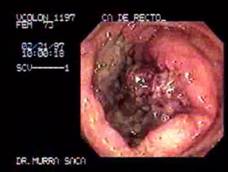 Rectum- Adenocarcinoma