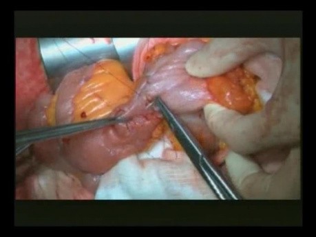Right Open Hemicolectomy – Technical Principles - Part 6