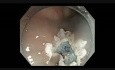 Colonoscopy Channel - Enodscopic Mucosal Resection Of A Subtle Cecal Lesion