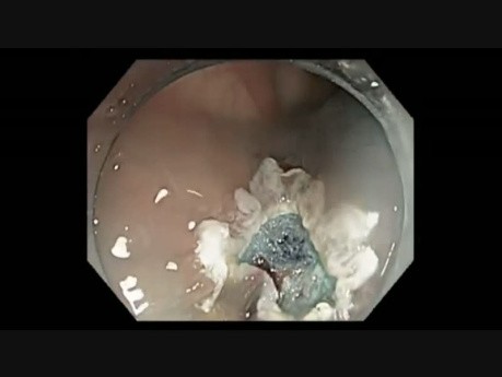 Colonoscopy Channel - Enodscopic Mucosal Resection Of A Subtle Cecal Lesion