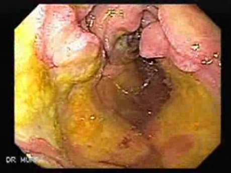 Gastroduodenal MALT lymphoma (8 of 9)