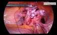 Laparoscopic Myomectomy for Large Fibroid Uterus and Cholecystectomy in same patient by Three Port.