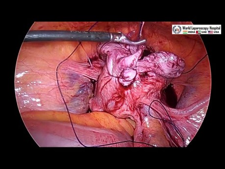 Laparoscopic Myomectomy for Large Fibroid Uterus and Cholecystectomy in same patient by Three Port.