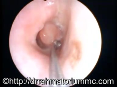 Middle Ear Polyp 