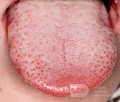 Dappled Tongue