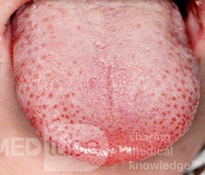 Dappled Tongue