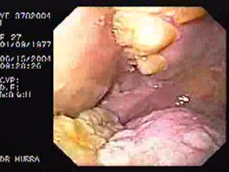 Oropharynge-Esophagic Candidiasis - Esophagitis (3 of 5)