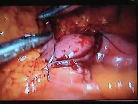 Jejunal Gastrointestinal Stromal tumor (GIST) (34 of 86)