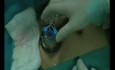 LESS Transvesical Removal of Mid-urethral Polypropylene Sling Eroded into the Bladder