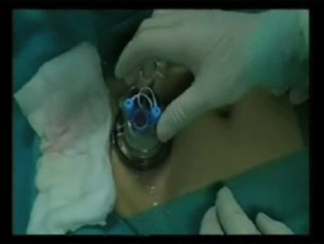 LESS Transvesical Removal of Mid-urethral Polypropylene Sling Eroded into the Bladder