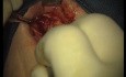 Rebuild Of Madnibular Implant Site (2/4)