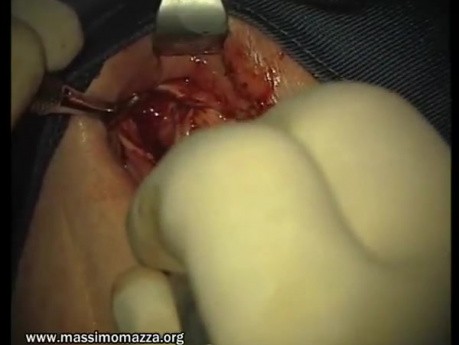 Rebuild Of Madnibular Implant Site (2/4)