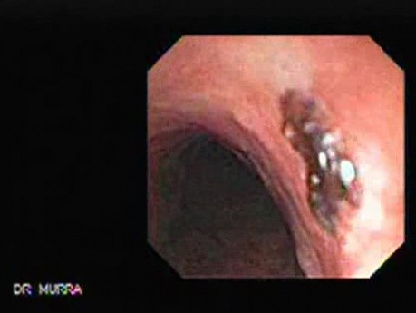 Tracheal Endoscopy - introduction through the fistula 4/5