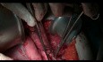 Supramesocolic Surgical Management of Pseudomyxoma Peritonei