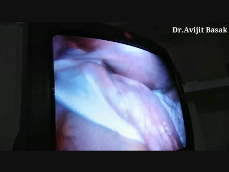 Huge Twisted Ovarian Cyst in Pregnancy Managed Laparoscopically by Dr.Avijit Basak