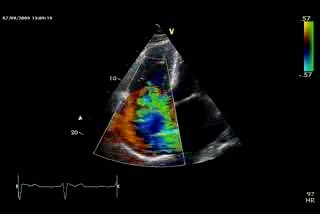 Tricuspid Valve Regurgitation