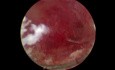 Endometrial Hyperplasia. Polyp of the uterine cavity?