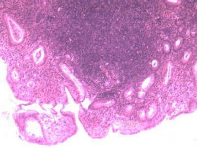 Ulcerative Colitis with Pseudopolyps (21 of 22)