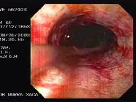 Acute Variceal Bleeding - Active Haemorrhage