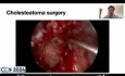 Cholesteatoma in the Mesotympanic Space. How to Manage a Deshiscent Facial Nerve?
