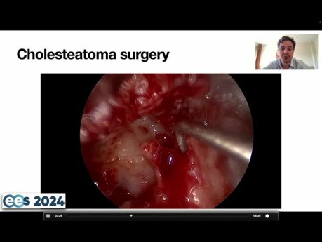 Cholesteatoma in the Mesotympanic Space. How to Manage a Deshiscent Facial Nerve?