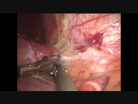 Laparoscopic Liver Resection