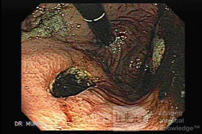 Gastric Cancer - Endoscopic Assessment of the Gastric Mucosa
