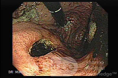 Gastric Cancer - Endoscopic Assessment of the Gastric Mucosa