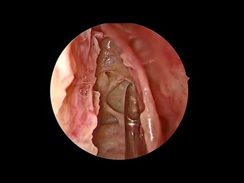 Etmoidectomia