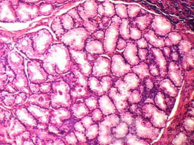 Brunner's Gland Adenoma (4 of 4)