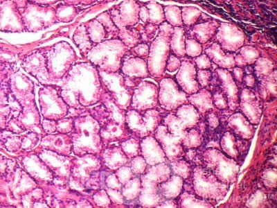 Brunner's Gland Adenoma (4 of 4)