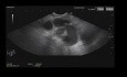 Endoscopic Ultrasound of Gastric Varices