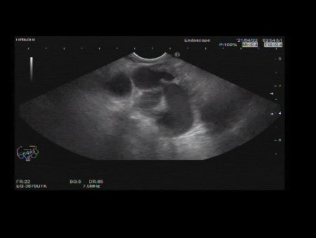 Endoscopic Ultrasound of Gastric Varices