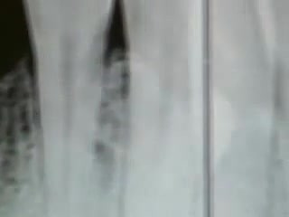 Implantation Of Lower Right Lateral Incisor