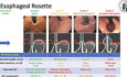 Role of Preoperative Endoscopy in Bariatric Surgery