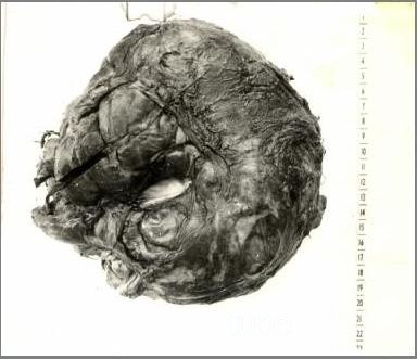 Paratesticular tumor