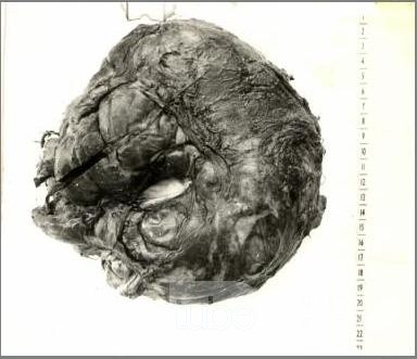 Paratesticular tumor