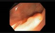 Colonoscopy Channel - How To Perform EMR - Lesion A