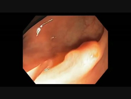 Colonoscopy Channel - How To Perform EMR - Lesion A