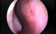 Little's Area Abnormal Vessels - Nose Bleeding