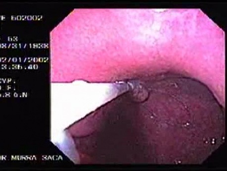 Gastric Polyps - Endoscopy (2 of 3)