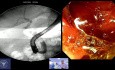 Mastering the Distal CBD, The 'Constrained-Bulb' Maneuver for Safe EPLBD