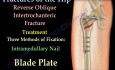 Hip Fractures and Fixation