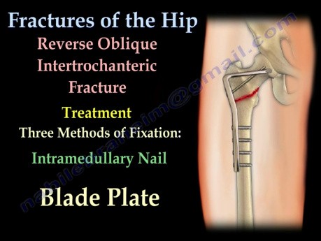 Hip Fractures and Fixation